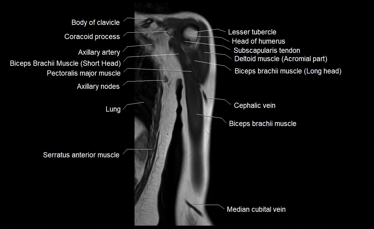 MRI upper arm (humerus ) coronal cross sectional anatomy image 6.webp